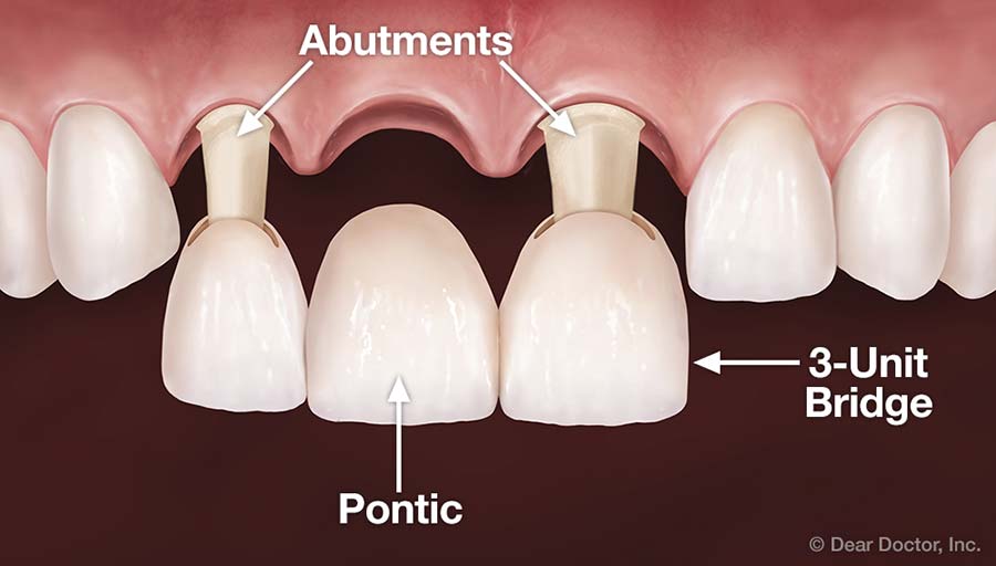 Dental Bridge.